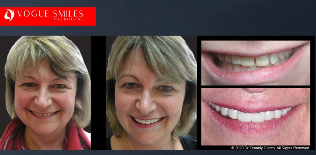 Before and After Photos Snap on Smile in Melbourne - Affordable Cosmetic Dentistry Alternative MELBOURNE AUSTRALIA