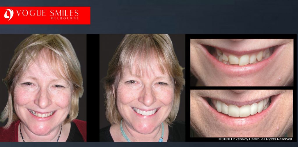 Before and After Photos Snap on Smile in Melbourne - Affordable Cosmetic Dentistry Alternative MELBOURNE AUSTRALIA