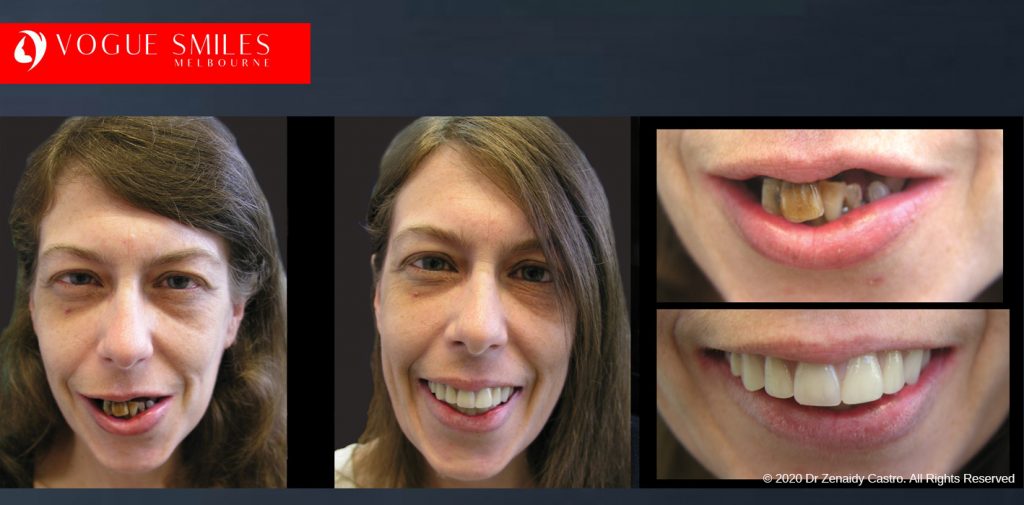 Before and After Photos Snap on Smile in Melbourne - Affordable Cosmetic Dentistry Alternative MELBOURNE AUSTRALIA