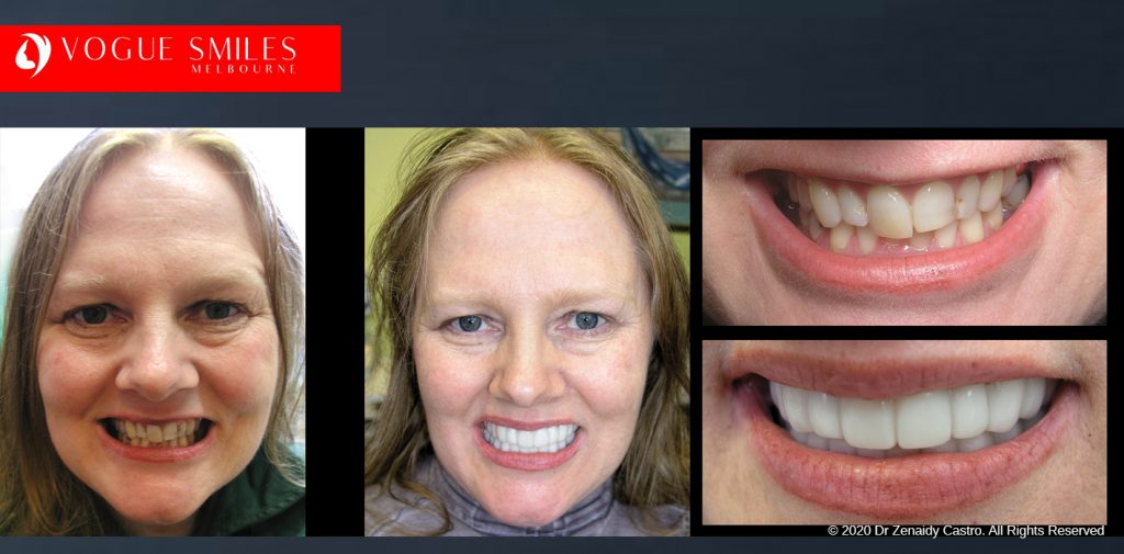 Before and After Photos Snap on Smile in Melbourne - Affordable Cosmetic Dentistry Alternative MELBOURNE AUSTRALIA