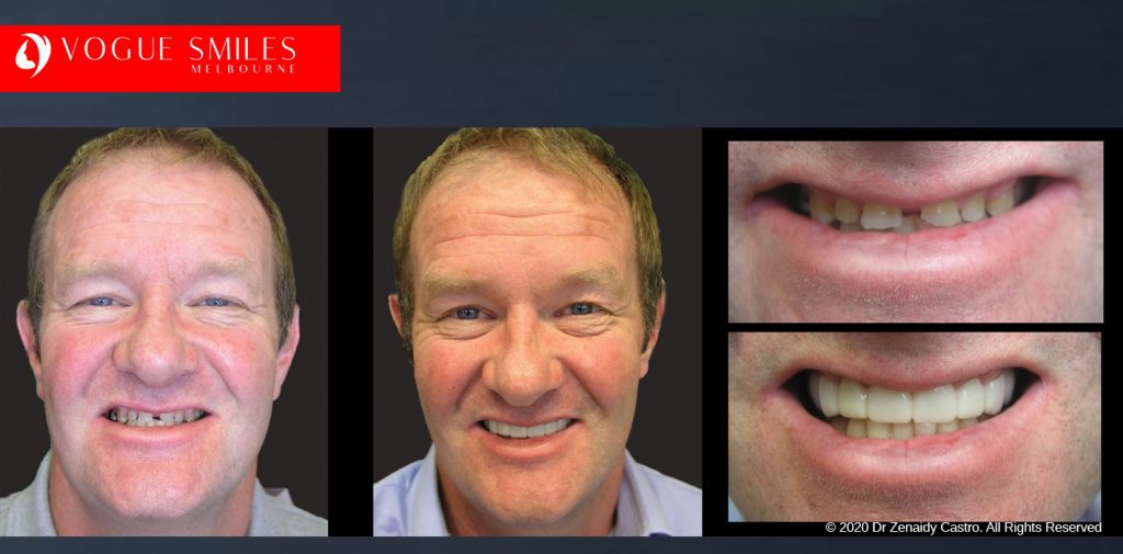 Before and After Photos Snap on Smile in Melbourne - Affordable Cosmetic Dentistry Alternative MELBOURNE AUSTRALIA