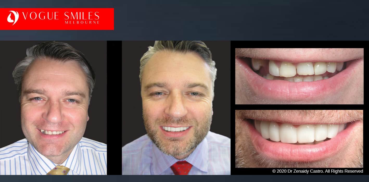 Snap On Dentures Before And After