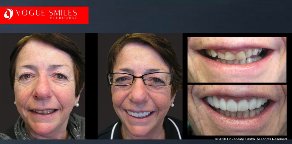 Before and After Photos Snap on Smile in Melbourne - Affordable Cosmetic Dentistry Alternative MELBOURNE AUSTRALIA