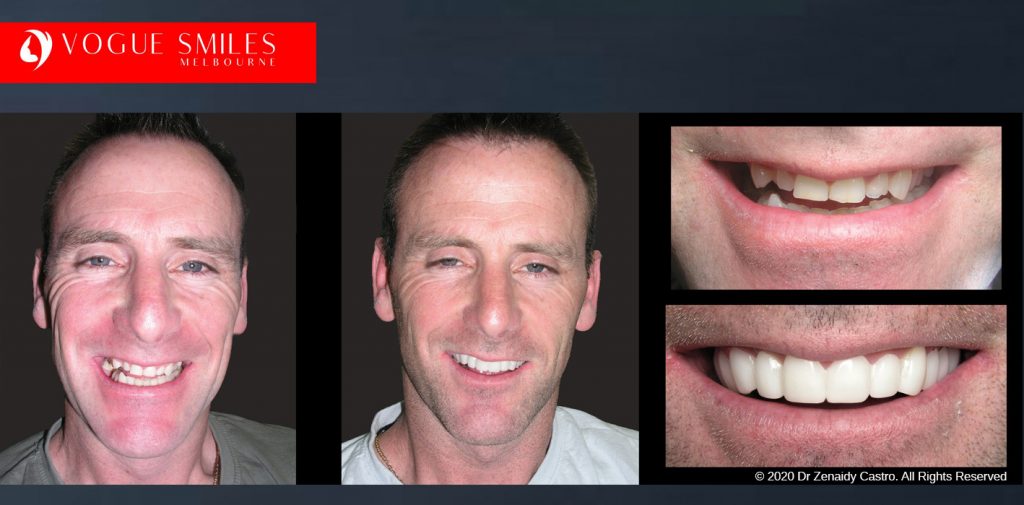 Before and After Photos Snap on Smile in Melbourne - Affordable Cosmetic Dentistry Alternative MELBOURNE AUSTRALIA