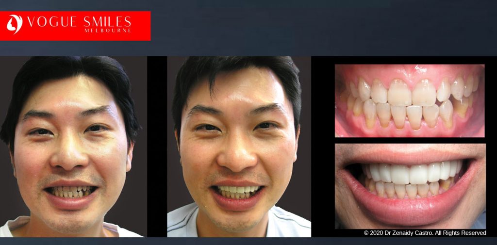 Before and After Photos Snap on Smile in Melbourne - Affordable Cosmetic Dentistry Alternative MELBOURNE AUSTRALIA