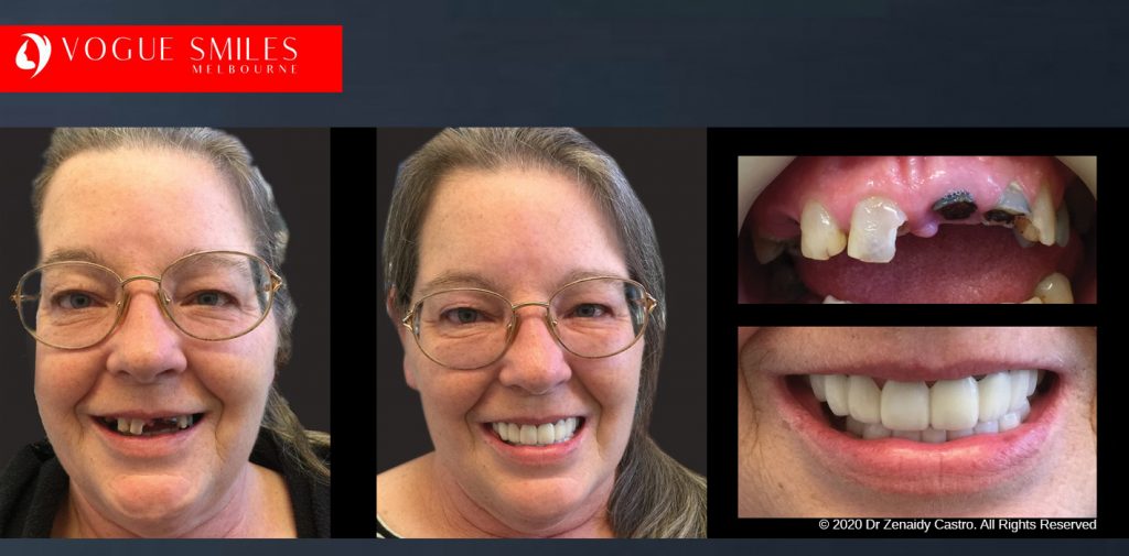 Before and After Photos Snap on Smile in Melbourne - Affordable Cosmetic Dentistry Alternative MELBOURNE AUSTRALIA