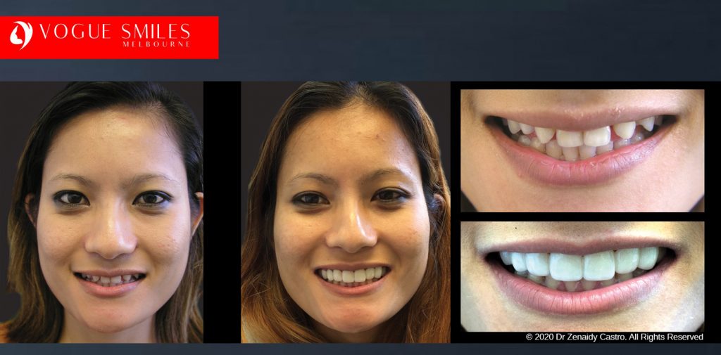 Before and After Photos Snap on Smile in Melbourne - Affordable Cosmetic Dentistry Alternative MELBOURNE AUSTRALIA