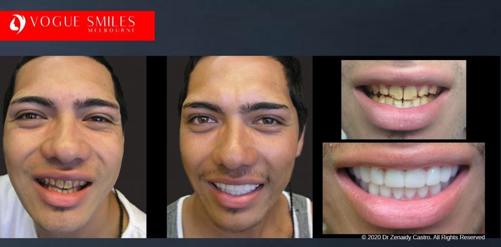 Before and After Photos Snap on Smile in Melbourne - Affordable Cosmetic Dentistry Alternative MELBOURNE AUSTRALIA