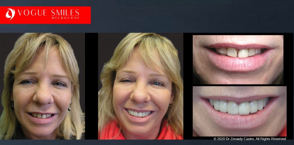 Before and After Photos Snap on Smile in Melbourne - Affordable Cosmetic Dentistry Alternative MELBOURNE AUSTRALIA