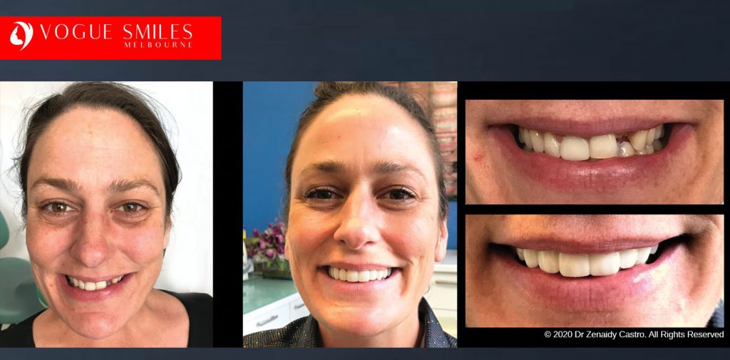 Before and After Photos Snap on Smile in Melbourne - Affordable Cosmetic Dentistry Alternative MELBOURNE AUSTRALIA