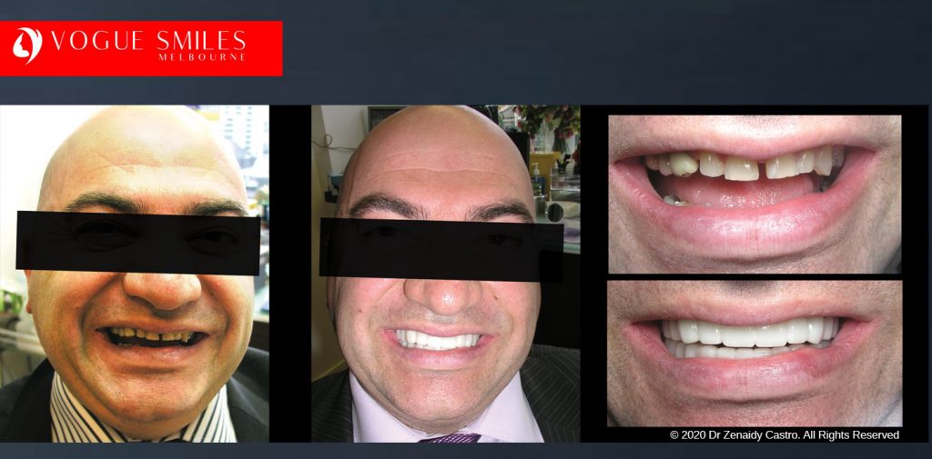 Affordable Cosmetic Dentistry Before & After - SNAP ON SMILE MELBOURNE AUSTRALIA