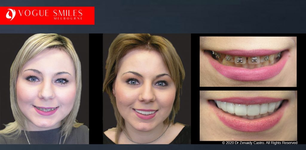 Before and After Photos Snap on Smile in Melbourne - Affordable Cosmetic Dentistry Alternative MELBOURNE AUSTRALIA