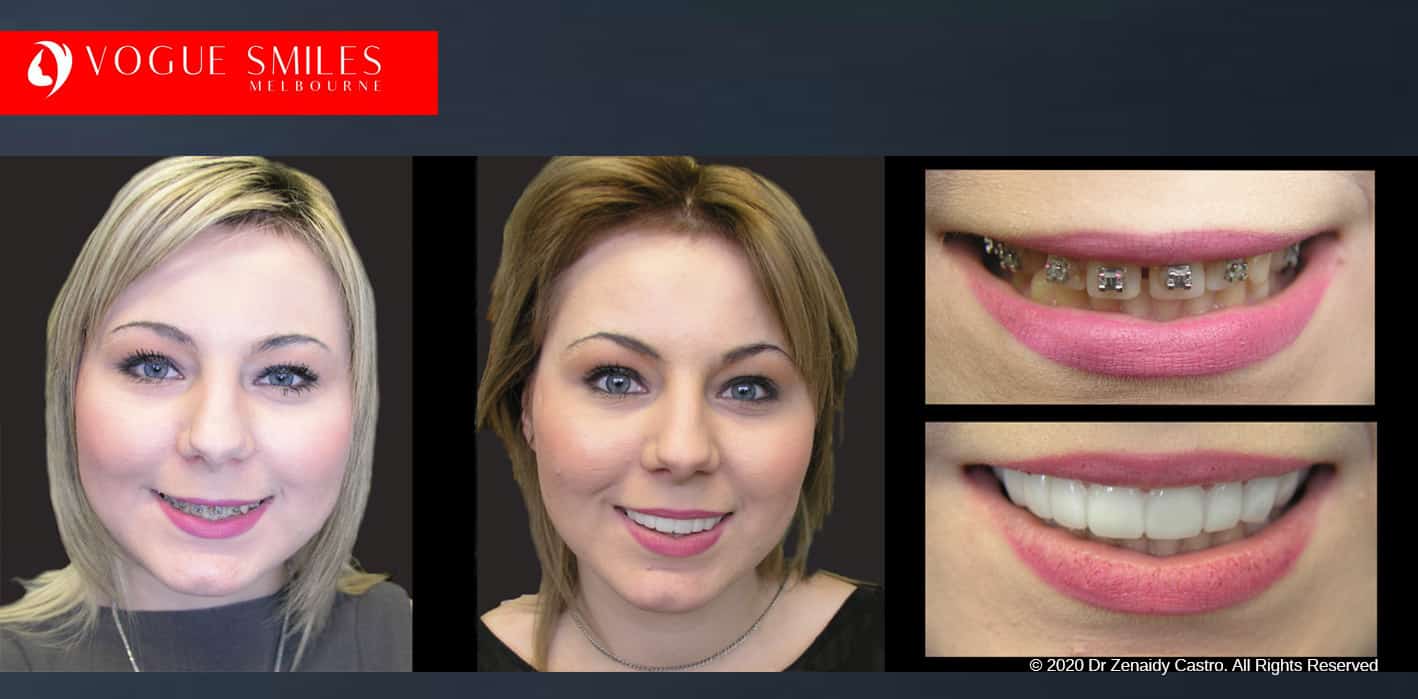 Snap on Smile Melbourne | Affordable Cosmetic Dentistry Alternative