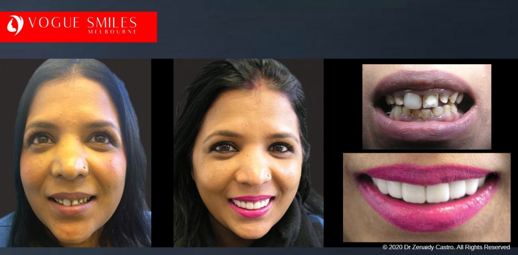 Before and After Photos Snap on Smile in Melbourne - Affordable Cosmetic Dentistry Alternative MELBOURNE AUSTRALIA