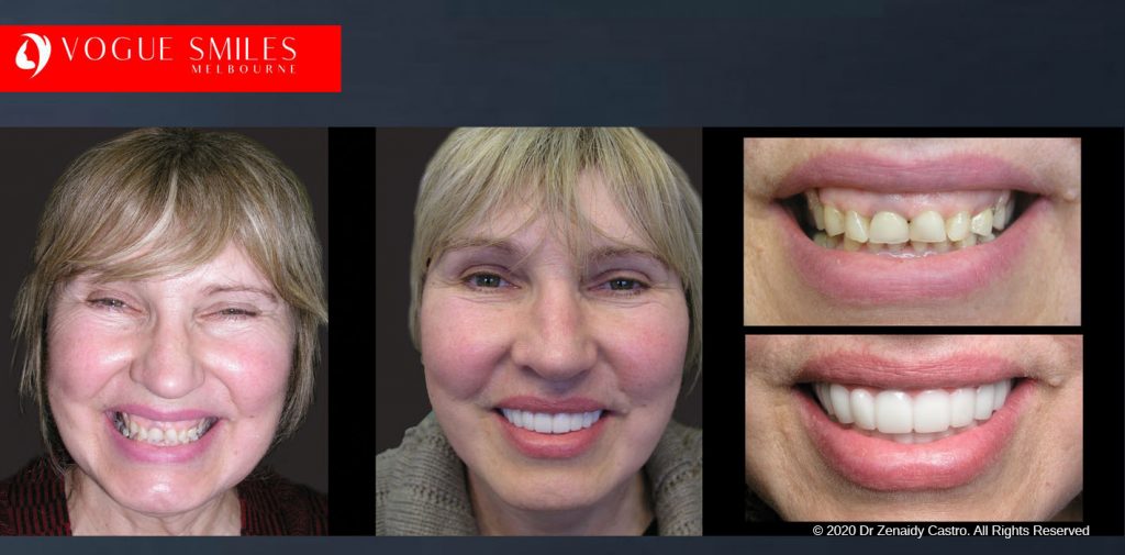 Before and After Photos Snap on Smile in Melbourne - Affordable Cosmetic Dentistry Alternative MELBOURNE AUSTRALIA