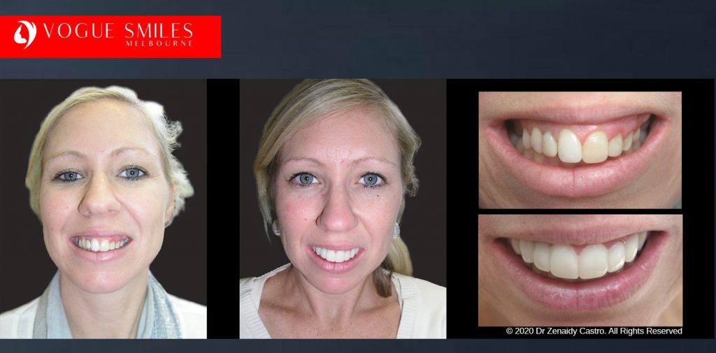 Before and After Photos Snap on Smile in Melbourne - Affordable Cosmetic Dentistry Alternative MELBOURNE AUSTRALIA