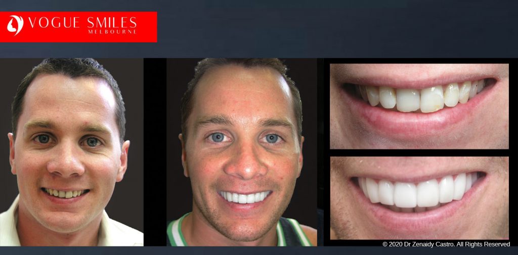 Before and After Photos Snap on Smile in Melbourne - Affordable Cosmetic Dentistry Alternative MELBOURNE AUSTRALIA