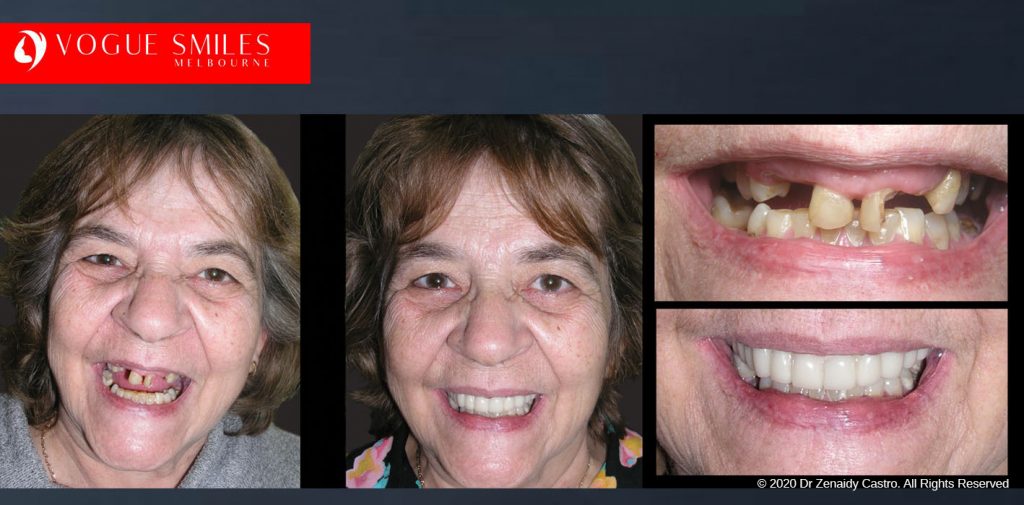 Before and After Photos Snap on Smile in Melbourne - Affordable Cosmetic Dentistry Alternative MELBOURNE AUSTRALIA