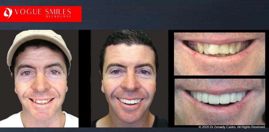 Before and After Photos Snap on Smile in Melbourne - Affordable Cosmetic Dentistry Alternative MELBOURNE AUSTRALIA