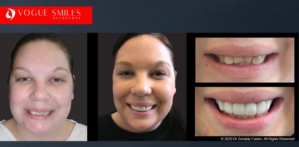 Before and After Photos Snap on Smile in Melbourne - Affordable Cosmetic Dentistry Alternative MELBOURNE AUSTRALIA