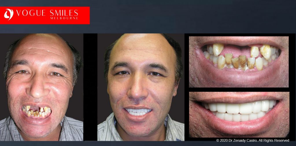 Before and After Photos Snap on Smile in Melbourne - Affordable Cosmetic Dentistry Alternative MELBOURNE AUSTRALIA