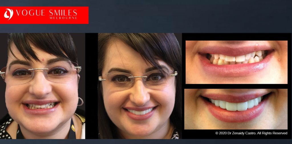 Before and After Photos Snap on Smile in Melbourne - Affordable Cosmetic Dentistry Alternative MELBOURNE AUSTRALIA