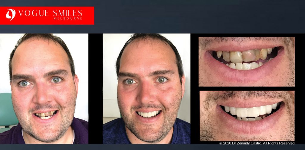 Before and After Photos Snap on Smile in Melbourne - Affordable Cosmetic Dentistry Alternative MELBOURNE AUSTRALIA