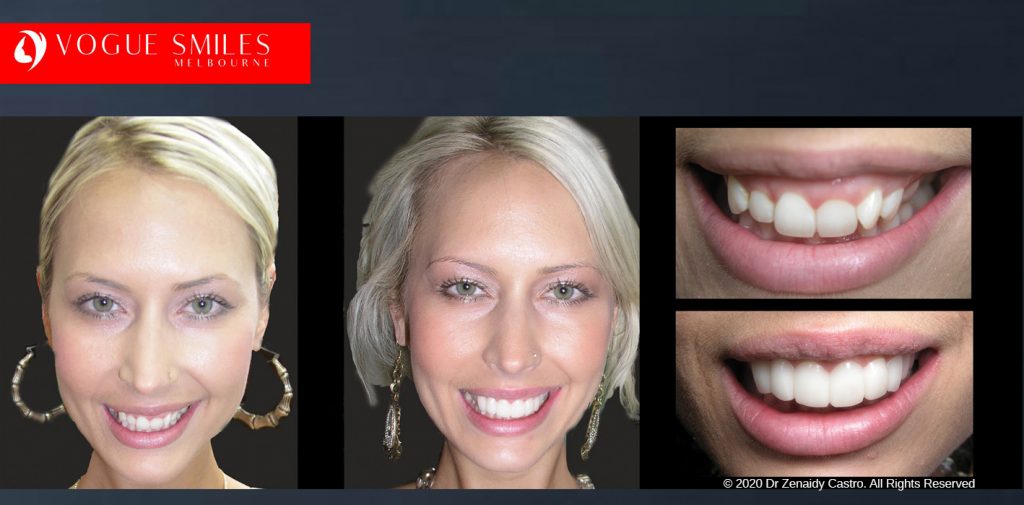 Before and After Photos Snap on Smile in Melbourne - Affordable Cosmetic Dentistry Alternative MELBOURNE AUSTRALIA