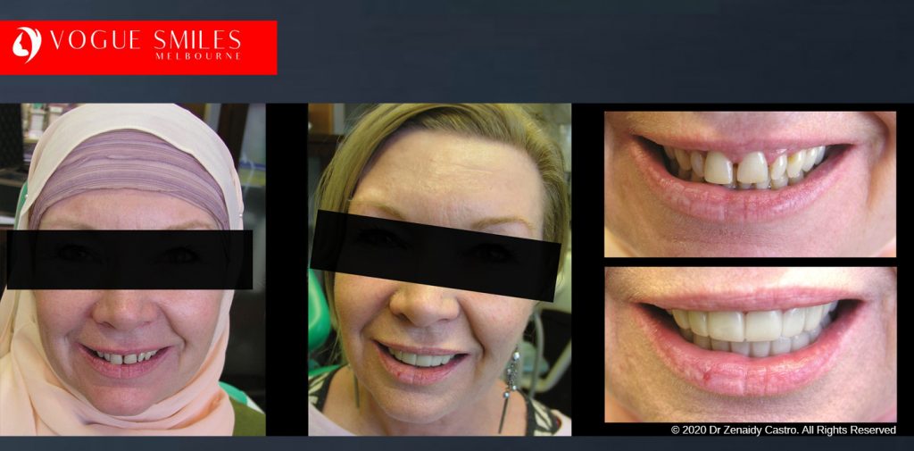 Before and After Photos Snap on Smile in Melbourne - Affordable Cosmetic Dentistry Alternative MELBOURNE AUSTRALIA