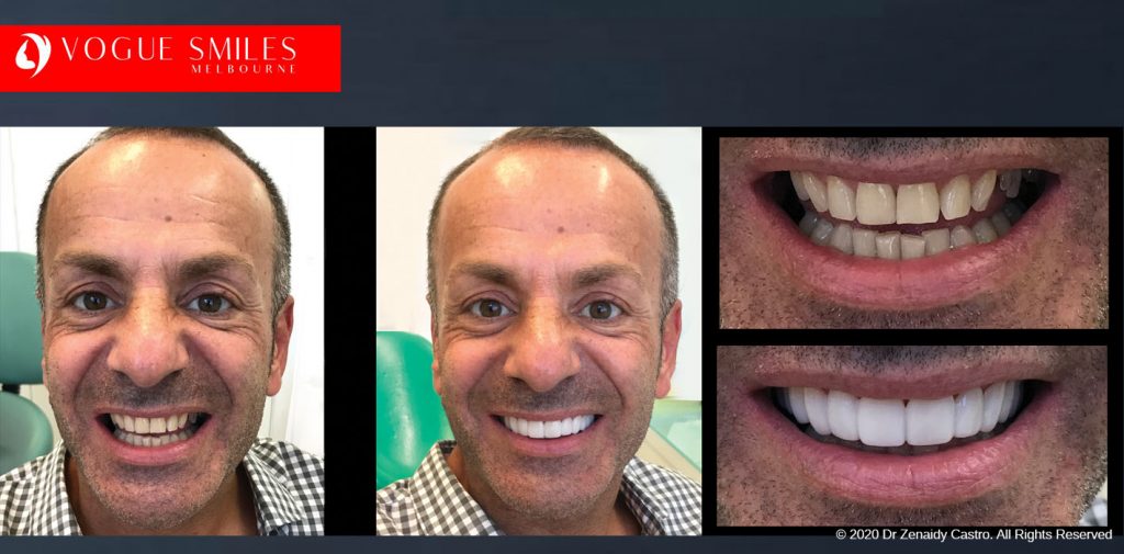 Before and After Photos Snap on Smile in Melbourne - Affordable Cosmetic Dentistry Alternative MELBOURNE AUSTRALIA