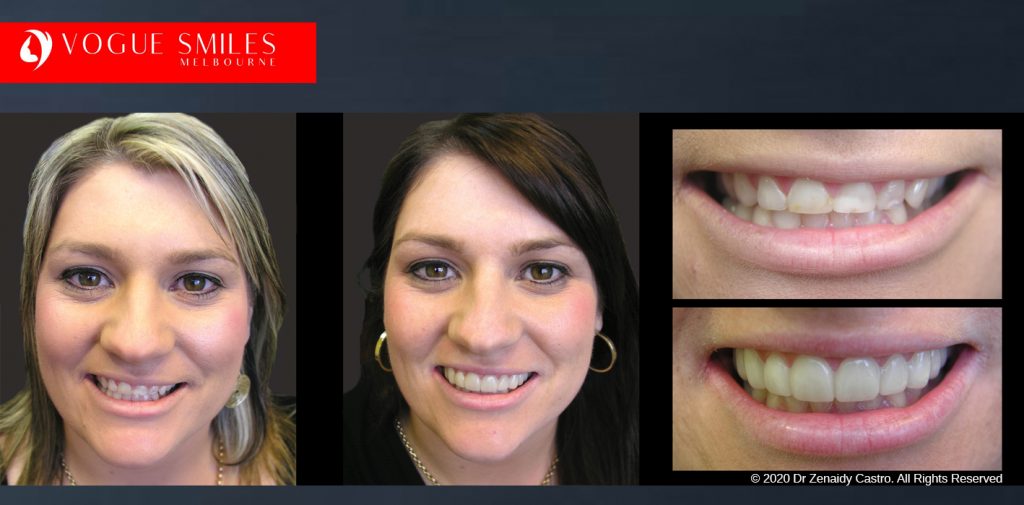 Before and After Photos Snap on Smile in Melbourne - Affordable Cosmetic Dentistry Alternative MELBOURNE AUSTRALIA