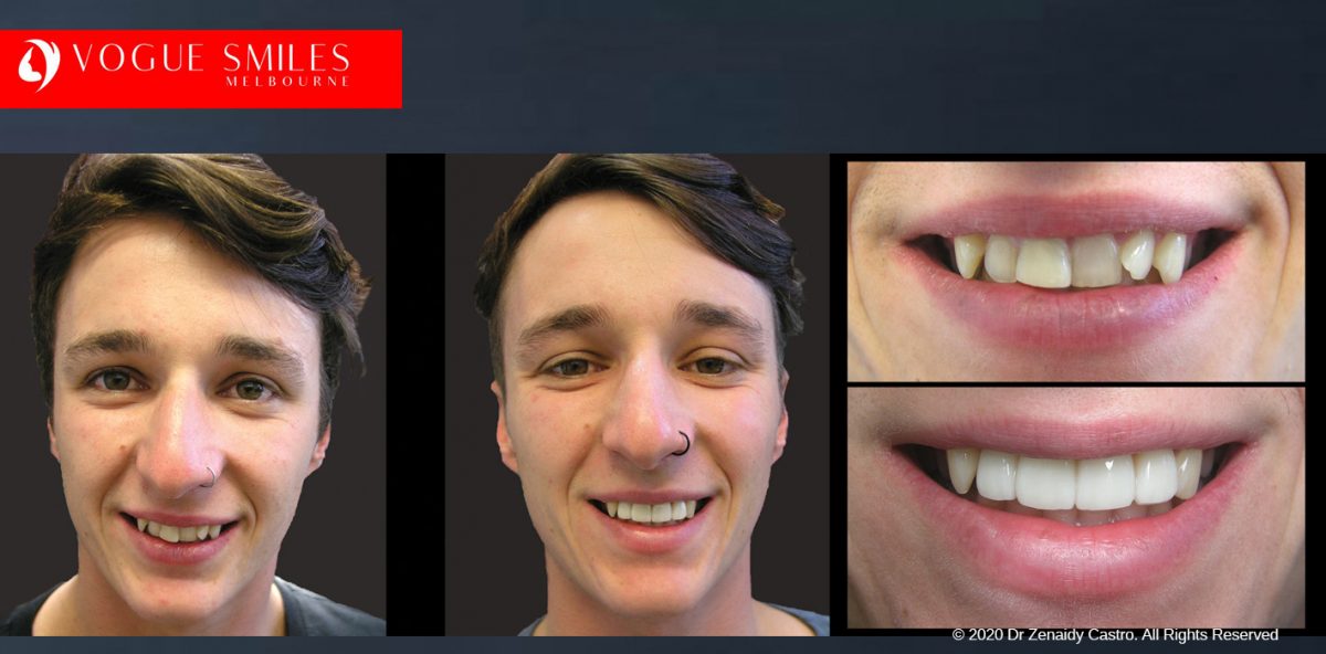 Crooked Teeth Before and After Gallery Melbourne CBD - Instantly Straighten Teeth - fix crooked teeth without braces