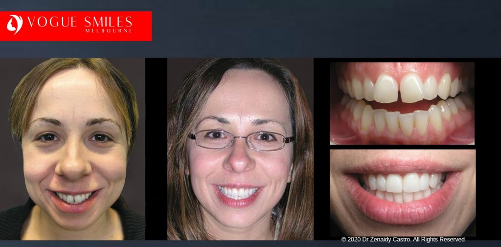 Crooked Teeth Before and After Gallery Melbourne CBD - Instantly Straighten Teeth - fix crooked teeth without braces