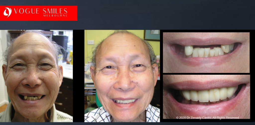 Affordable Dental Crowns and Dental Bridges Melbourne BEFORE & AFTER - Tooth Capping Melbourne - Implant replacement with Bridgework