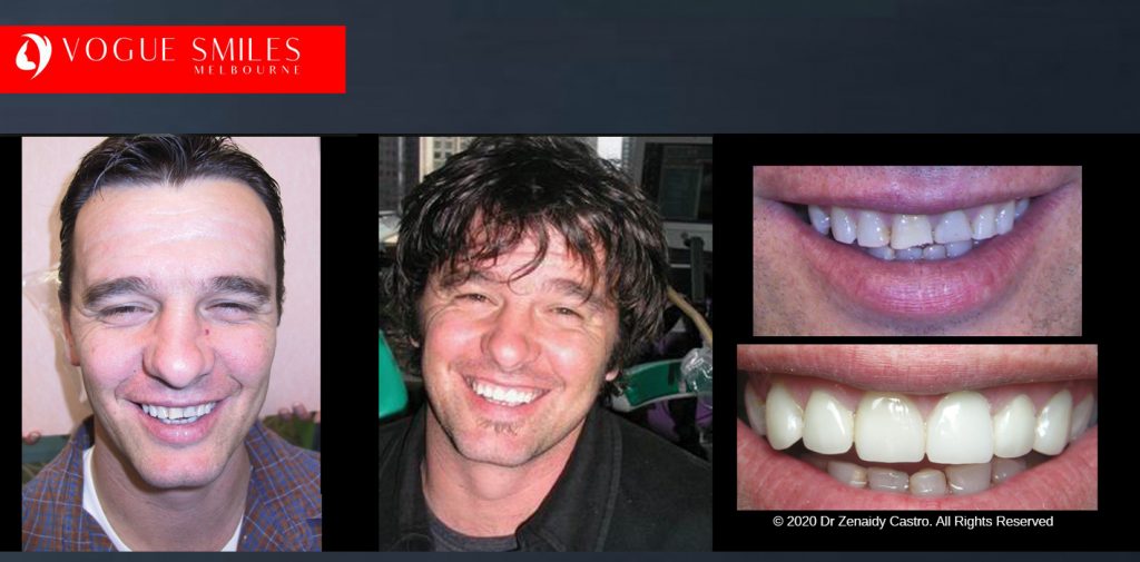 Affordable Dental Crowns and Dental Bridges Melbourne BEFORE & AFTER - Tooth Capping Melbourne - Implant replacement with Bridgework