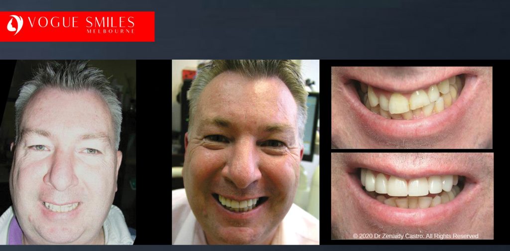 Affordable Dental Crowns and Dental Bridges Melbourne BEFORE & AFTER - Tooth Capping Melbourne - Implant replacement with Bridgework