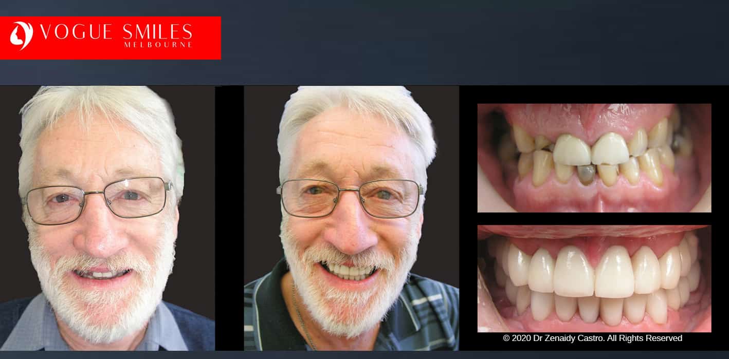 Porcelain Dental Crowns in Melbourne Before and After, Dental Bridges in Melbourne Before and After, Dental Crowns and Dental Bridges Melbourne CBD Before and After