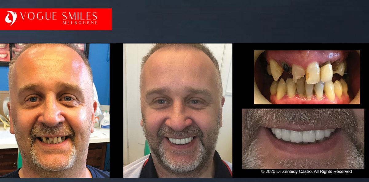 Treatment to Badly Broken down and damaged Tooth