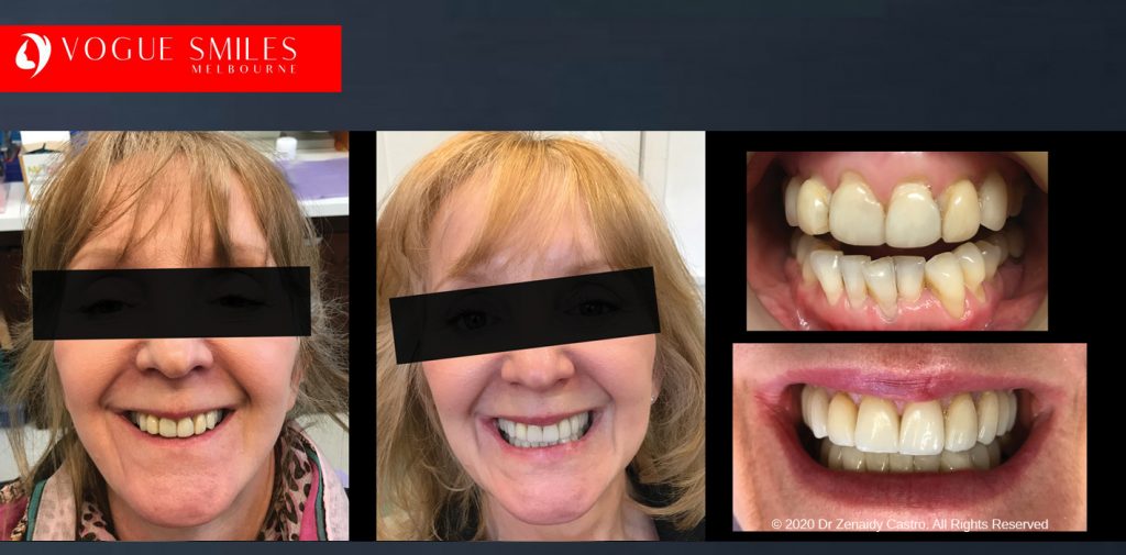 Affordable Dental Crowns and Dental Bridges Melbourne BEFORE & AFTER - Tooth Capping Melbourne - Implant replacement with Bridgework