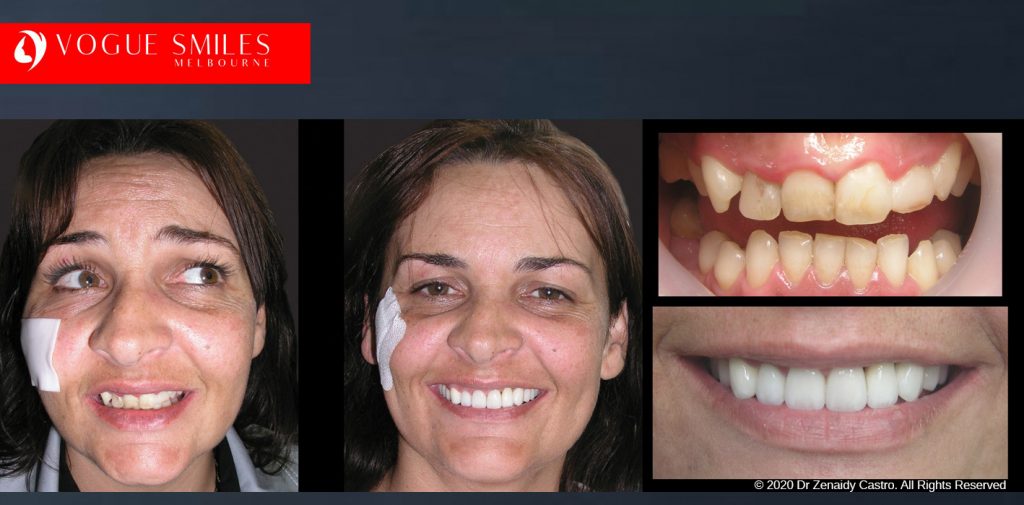 Porcelain Veneers Before and After Melbourne - Veneer Cost Melbourne From $700 per tooth *- Dental Veneers Smile Gallery - VOGUE SMILES COSMETIC DENTAL