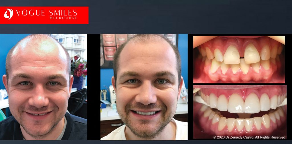 Composite Bonding vs. Porcelain Veneers Melbourne – Which One Is Right for You?