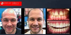 Composite Bonding vs. Porcelain Veneers Melbourne – Which One Is Right for You?