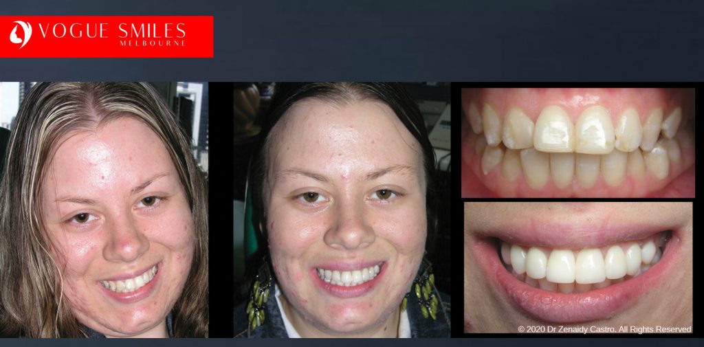 Porcelain Veneers Before and After Melbourne - Veneer Cost Melbourne From $700 per tooth *- Dental Veneers Smile Gallery - VOGUE SMILES COSMETIC DENTAL