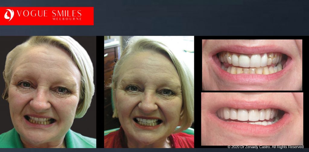 Porcelain Veneers Before and After Melbourne - Veneer Cost Melbourne From $700 per tooth *- Dental Veneers Smile Gallery - VOGUE SMILES COSMETIC DENTAL