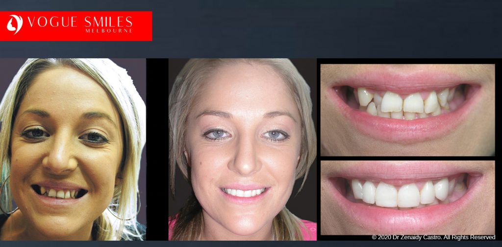 Porcelain Veneers Before and After Melbourne - Veneer Cost Melbourne From $700 per tooth *- Dental Veneers Smile Gallery - VOGUE SMILES COSMETIC DENTAL