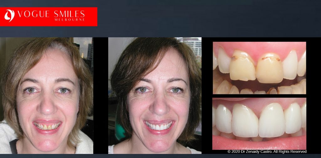 Porcelain Veneers Before and After Melbourne - Veneer Cost Melbourne From $700 per tooth *- Dental Veneers Smile Gallery - VOGUE SMILES COSMETIC DENTAL