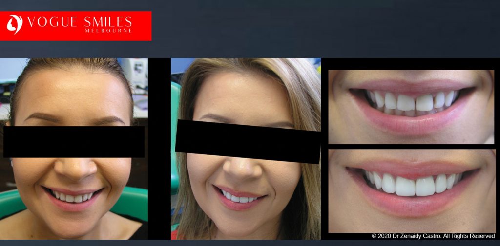 Porcelain Veneers Before and After Melbourne - Veneer Cost Melbourne From $700 per tooth *- Dental Veneers Smile Gallery - VOGUE SMILES COSMETIC DENTAL