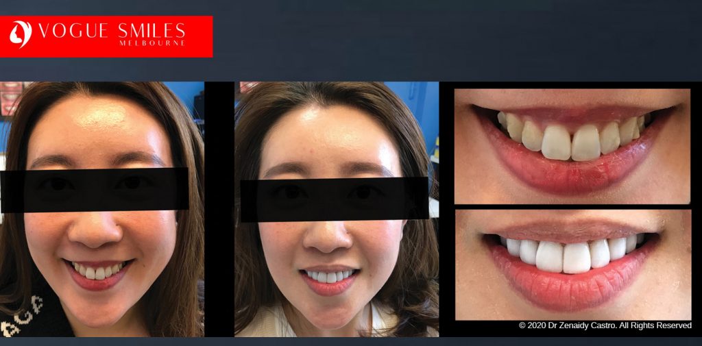 Porcelain Veneers Before and After Melbourne - Veneer Cost Melbourne From $700 per tooth *- Dental Veneers Smile Gallery - VOGUE SMILES COSMETIC DENTAL