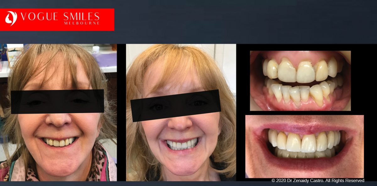 Porcelain Veneers Before and After Melbourne - Veneer Cost Melbourne From $700 per tooth *- Dental Veneers Smile Gallery - VOGUE SMILES COSMETIC DENTAL