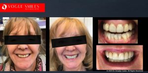 Non-surgical facelift options without Invasive Surgery in Melbourne & Noble Park North